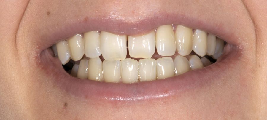 Bleaching, Vor der Zahnaufhellung