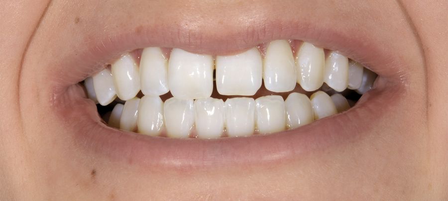 Bleaching, Nach der Zahnaufhellung